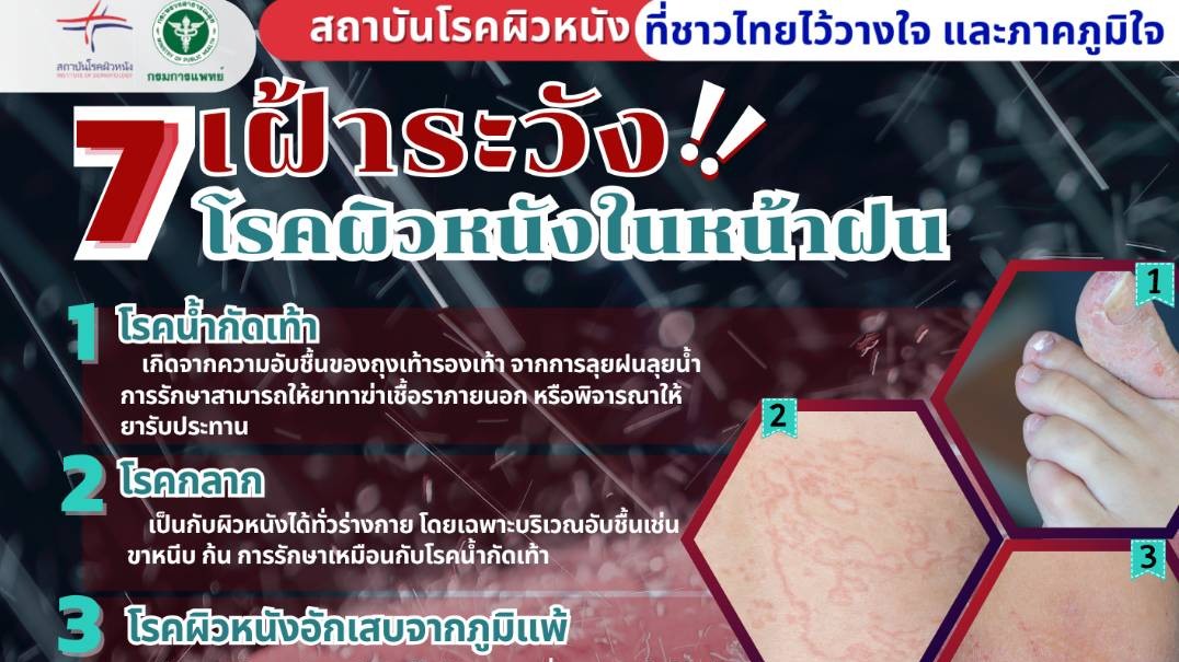 เฝ้าระวัง โรคผิวหนังในหน้าฝน