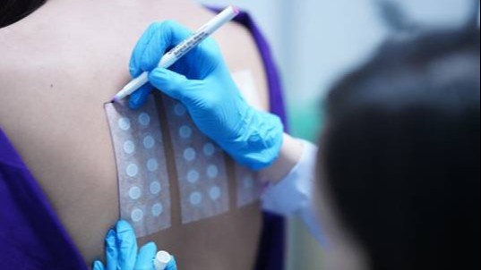 การทดสอบผื่นแพ้สัมผัส (Patch Test)