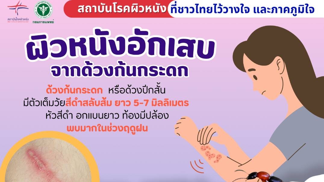 ผิวหนังอักเสบจากด้วงก้นกระดก