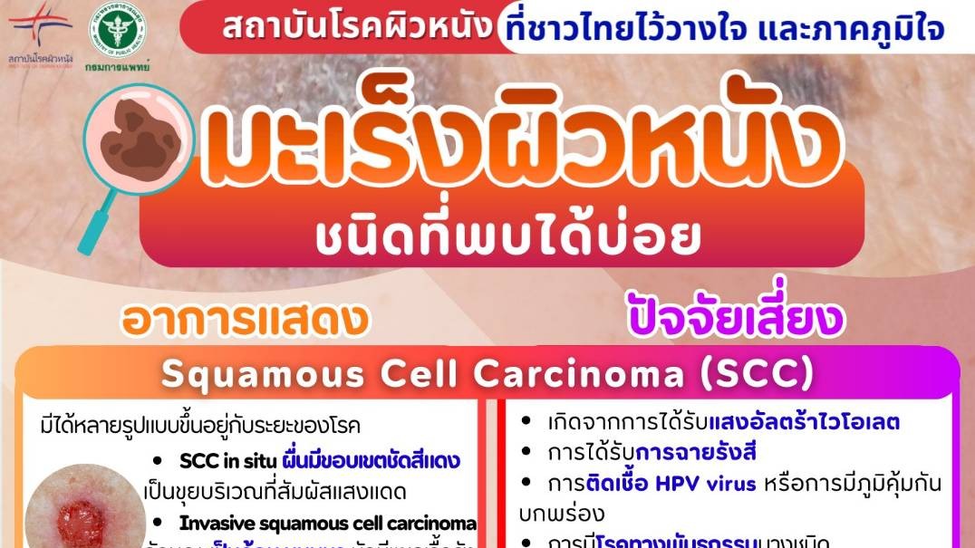 มะเร็งผิวหนังชนิดที่พบได้บ่อย