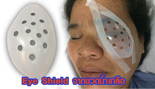 รพ.ศรีสังวรสุโขทัย ประดิษฐ์ ฝาครอบตา (Eye Shield) ป้องกันลม ฝุ่นละออง หลังผ่าตัด จากขวดน้ำเกลือ