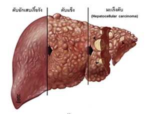 รณรงค์ป้องกันตับอักเสบ คนไทย50%ได้รักษา เปิด104รพ.ตรวจหาฟรี